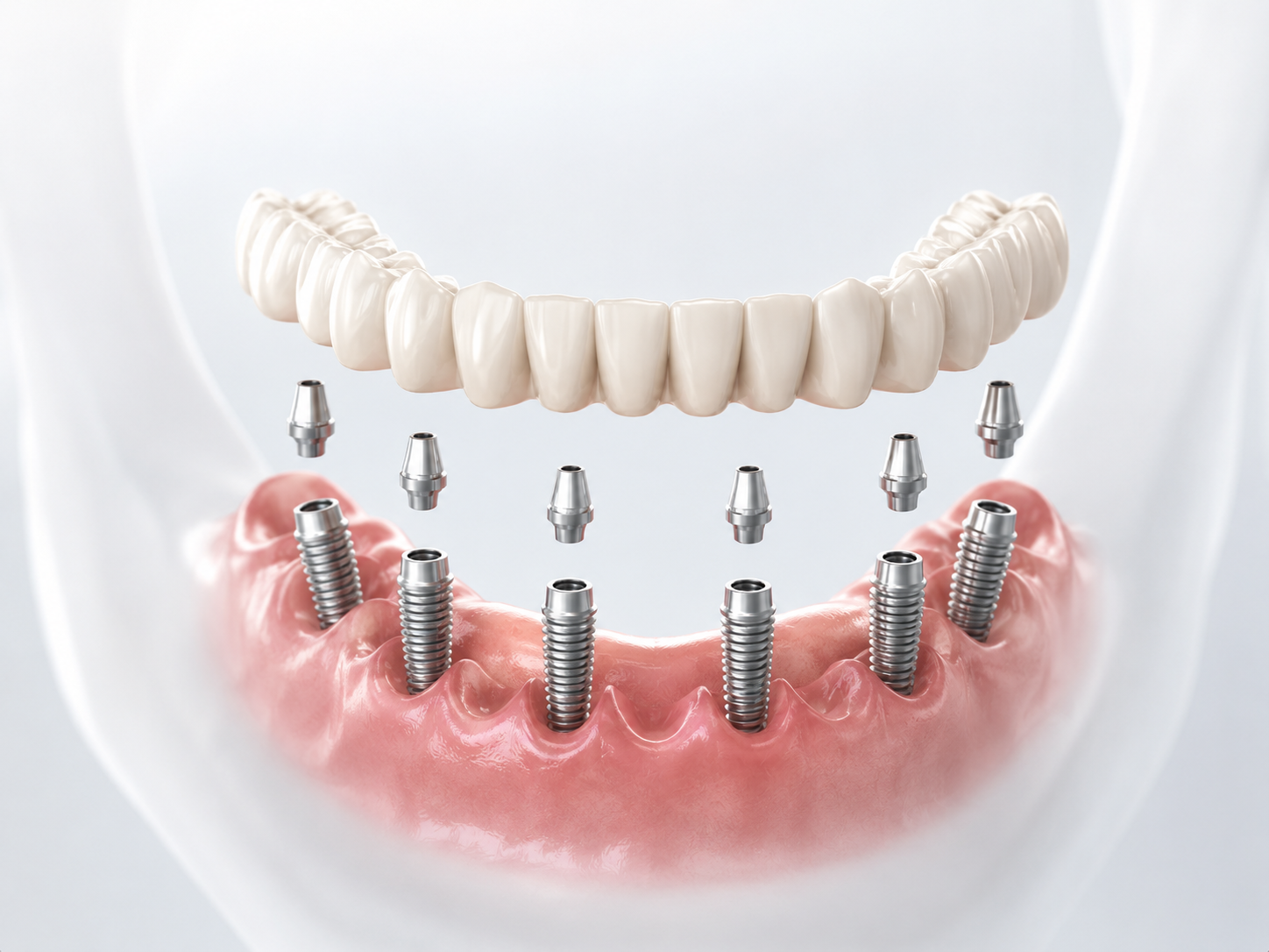 Tratamiento de implantes dentales arcada inferior Barcelona