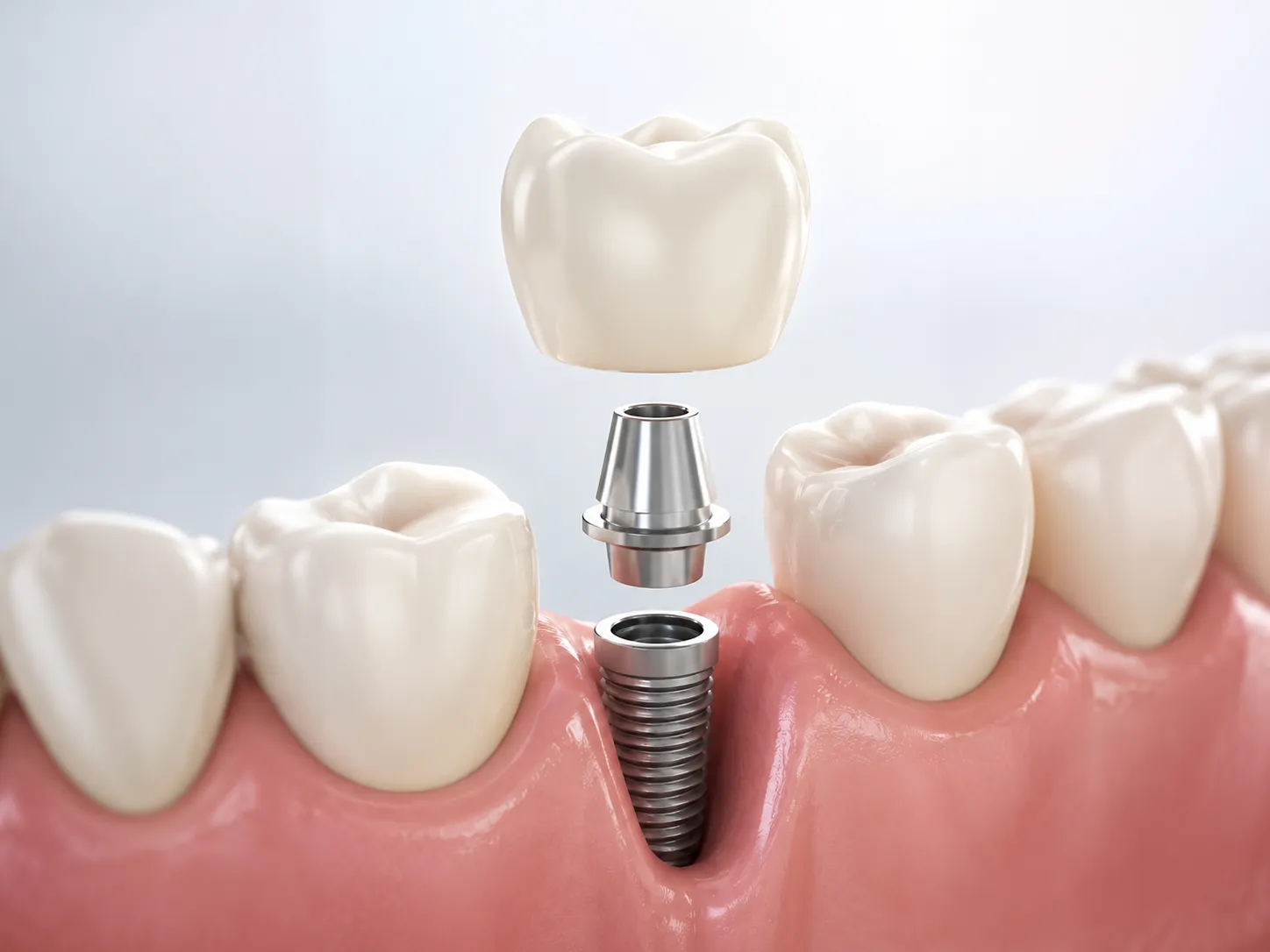 Implantes dentales con planificación digital y cirugía guiada