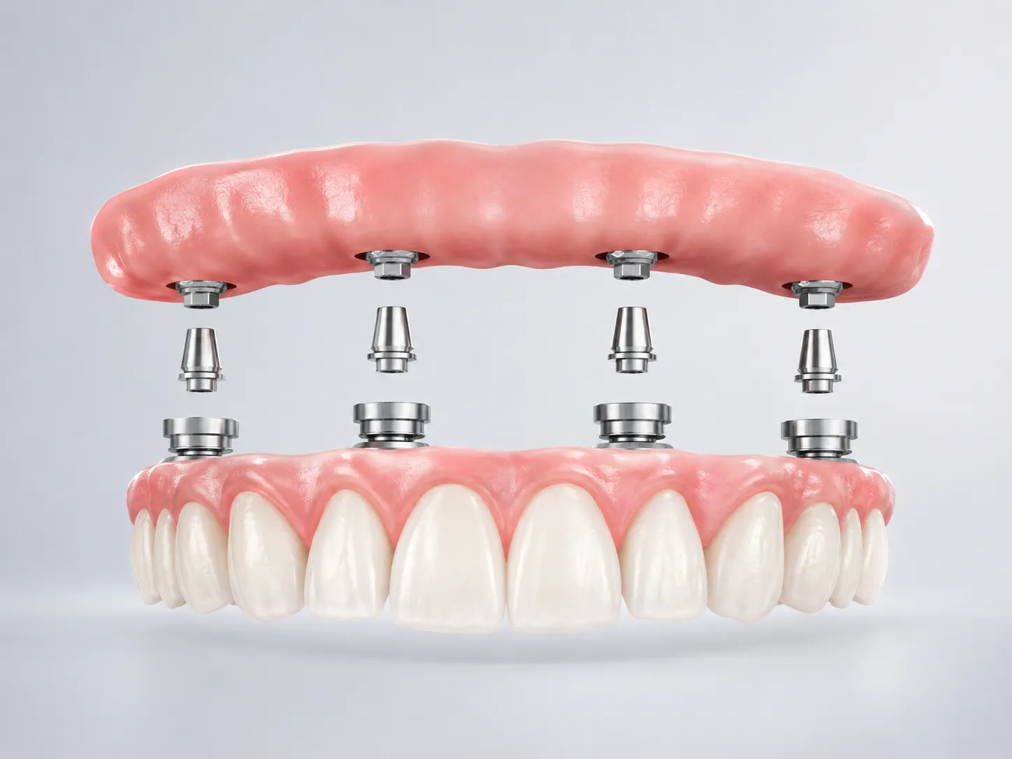 Tratamiento All-on-4 implantes dentales Barcelona