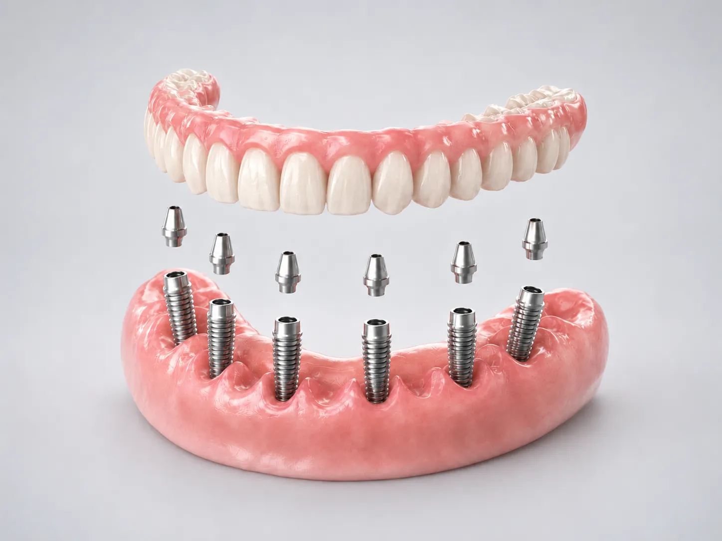 Tratamiento All-on-6 implantes dentales Barcelona